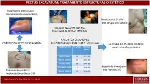 Pectus excavatum. Tratamiento quirúrgico: ¿estructural o estético?