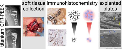 Inflammatory tissue response in human soft tissue is caused by a higher particle load near carbon fiber-reinforced PEEK compared to titanium plates