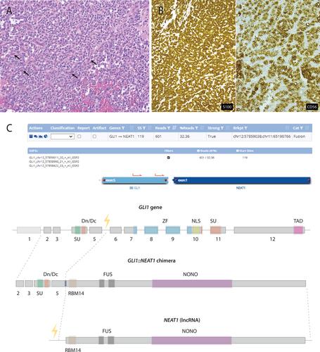 Recurrent and novel fusions detected by targeted RNA sequencing as part of the diagnostic workflow of soft tissue and bone tumours