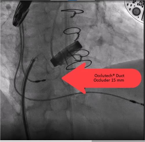 Complications of transcatheter paravalvular leak device closure of mitral valve: An updated review of the literature and a rare case presentation