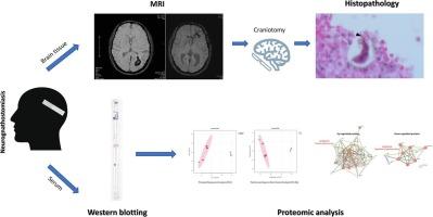 Detection of Gnathostoma spinigerum larva in the brain with complete follow-up after surgical treatment of human neurognathostomiasis