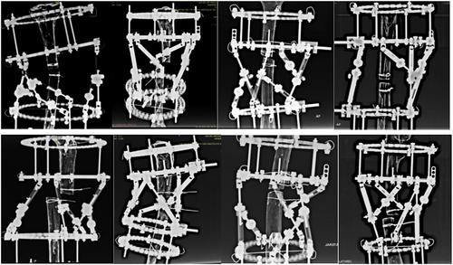 A new ring fixator system for automated bone fixation