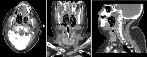 Mucosal emphysematous head and neck infections: Scoping review and a case of emphysematous tonsillitis