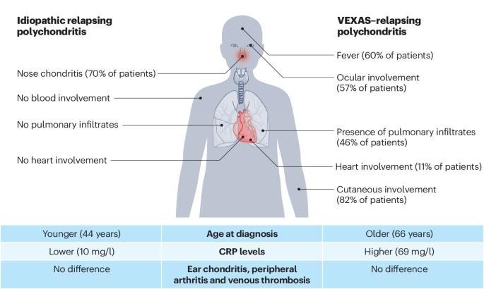 Relapsing polychondritis: clinical updates and new differential diagnoses