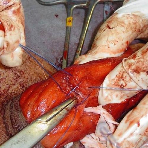 Modified Essed–Schroder Technique in Congenital Penile Curvature: Long-Term Outcomes and Quality of Life Evaluation