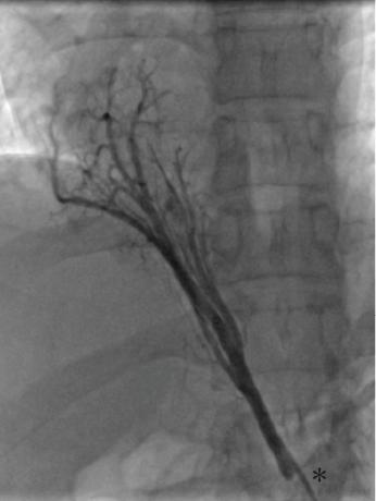 Transcatheter Embolization in Congenital Cardiovascular Malformations—Variable Use of Vascular Plugs