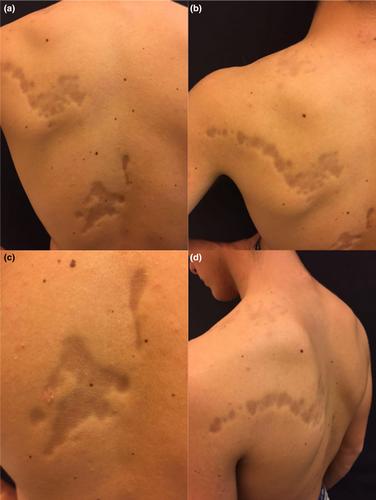 Linear atrophoderma of Moulin