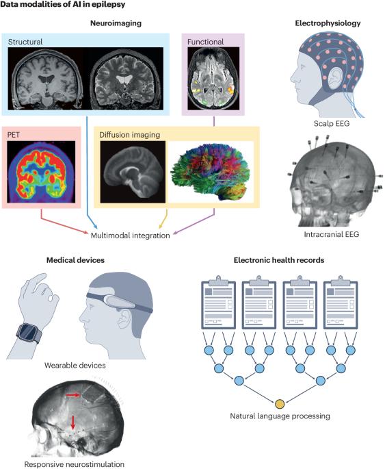 Artificial intelligence in epilepsy — applications and pathways to the clinic