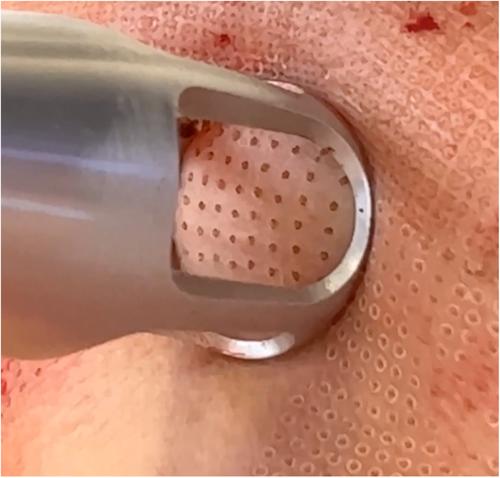 Histological analysis of laser-enabled tissue coring with a novel 2910 nm erbium-doped fluoride glass fiber laser