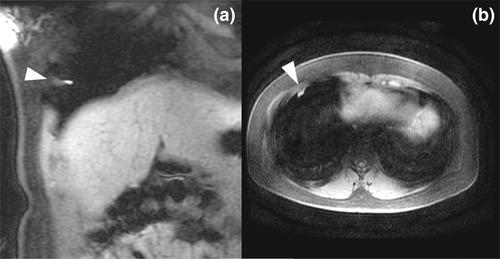 Endometriosis MRI: Atypical cases, pitfalls and mimics