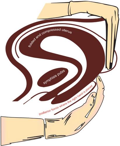 Why the Mostafa Maged maneuver is better: Mostafa Maged maneuver compared with bimanual uterine compression for postpartum hemorrhage