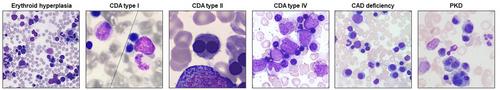 Updates on clinical and laboratory aspects of hereditary dyserythropoietic anemias