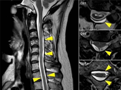 Chronic cerebrospinal fluid leak can cause amyotrophic lateral sclerosis mimic