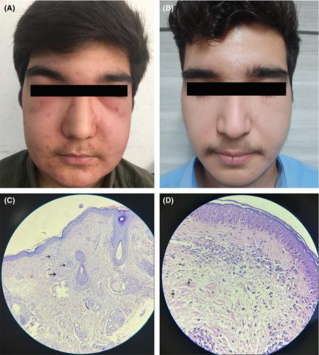 Successful treatment of a Morbihan's disease patient after a therapeutic challenge: A case report and comprehensive literature review