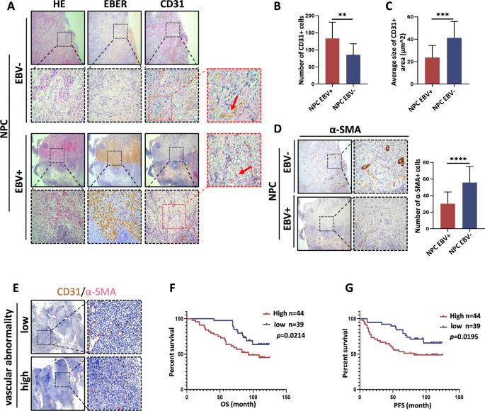 Epstein-Barr virus causes vascular abnormalities in epithelial malignancies through upregulating ANXA3-HIF-1α-VEGF pathway