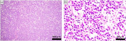 Seminoma in a 46, XY patient with 17α-hydroxylase deficiency