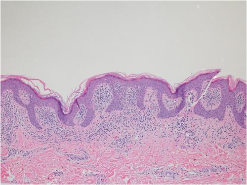 Null T-cell phenotype mycosis fungoides with aberrant CD20 and CD56 expression: A diagnostic dilemma