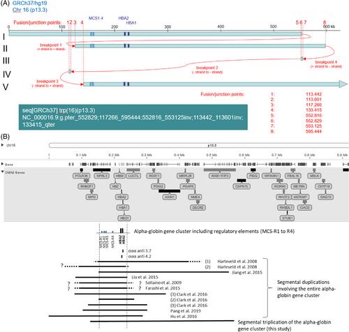 Moderate–severe beta-thalassemia intermedia phenotype caused by sextuplicated alpha-globin gene allele in two beta-thalassemia carriers