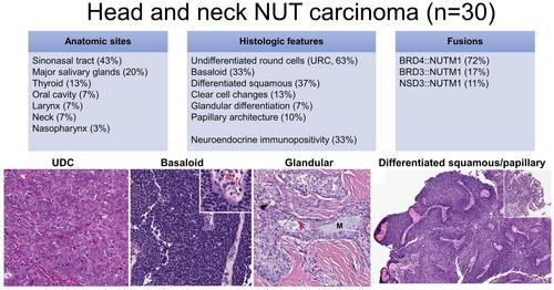 The histological spectrum and immunoprofile of head and neck NUT carcinoma: A multicentre series of 30 cases