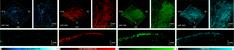 High-frequency photoacoustic and ultrasound imaging for skin evaluation: Pilot study for the assessment of a chemical burn