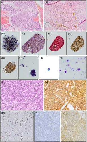 A six-year comprehensive review of eye cytology cases received at a tertiary level hospital