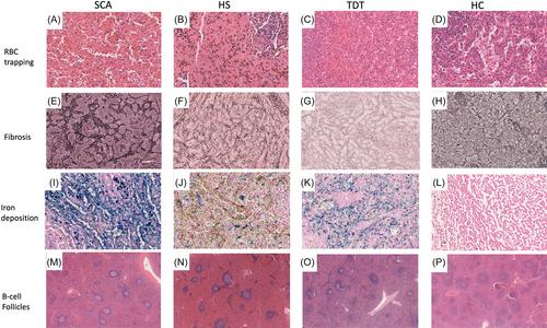 Comparative histological analysis of spleens in pediatric patients with hemolytic anemias: Insights into the pathophysiological mechanisms of spleen destruction in sickle cell anemia