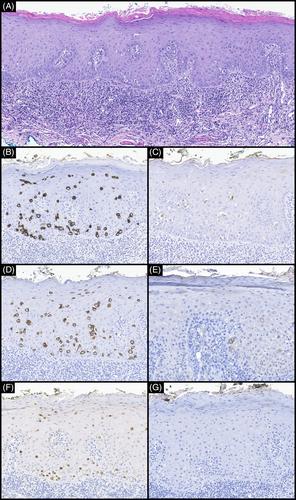 Unusual case of extramammary Paget disease of the oral mucosa: A case report and literature review