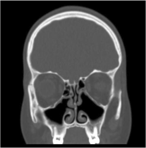 The criteria for chronic rhinosinusitis in children with cystic fibrosis are rarely fulfilled after initiation of CFTR modulator treatment