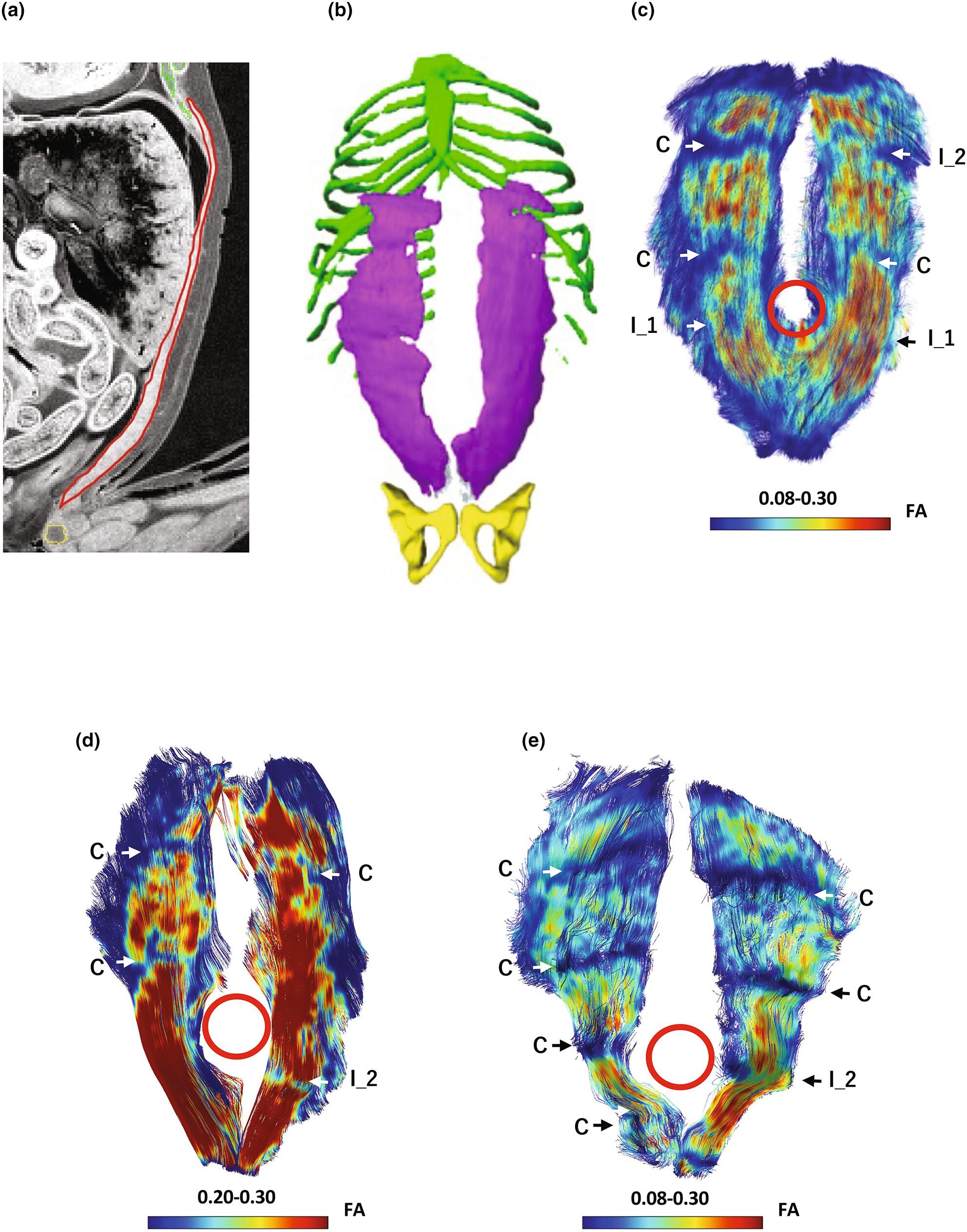 Formation of tendinous intersections in the human fetal rectus abdominis