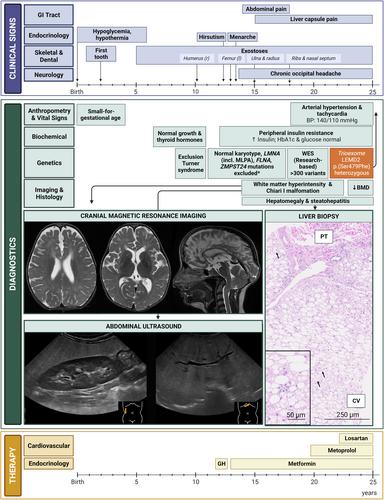 LEMD2-associated progeroid syndrome: Expanding the phenotype of the nuclear envelopathy caused by a defect in LEMD2 gene