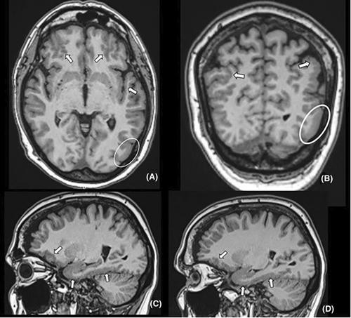 Novel LAMC3 pathogenic variant enriched in Finnish population causes malformations of cortical development and severe epilepsy