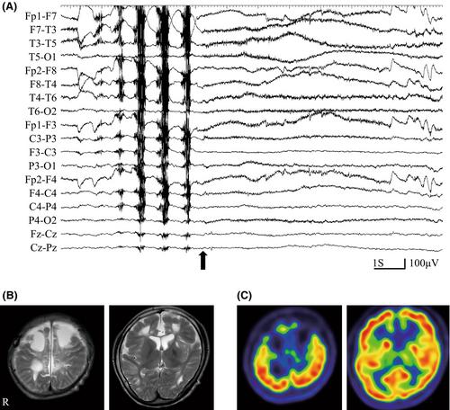 Remission of startle epilepsy provoked by acoustic stimuli following complete callosotomy: A case study