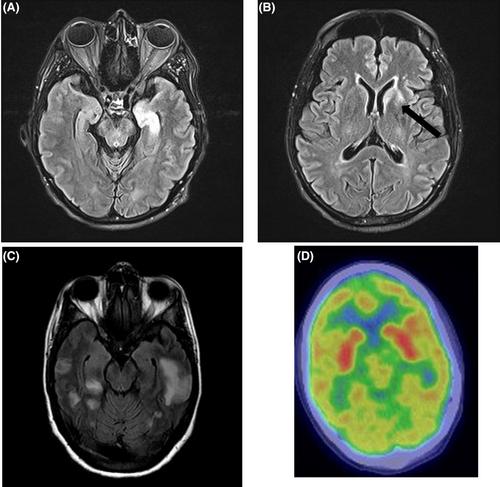 Autoimmune-associated seizure disorders