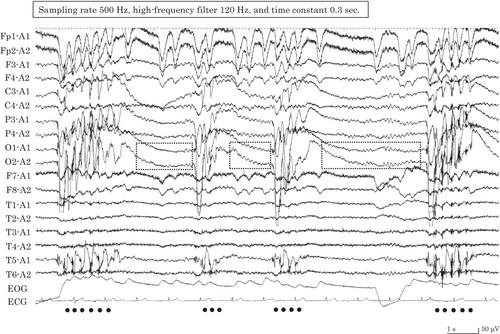 Hyperventilation-induced cerebellar fit in a patient with Chiari 1.5 malformation