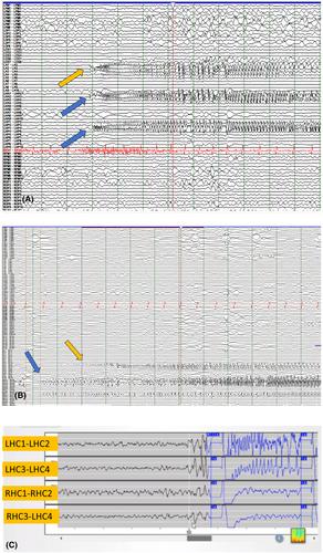 Extremely long RNS implantation effect: The extended impact of RNS electrodes on clinical and ECoG findings without the confounding effect of RNS stimulation