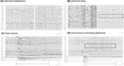 Seizure and movement disorder in CACNA1E developmental and epileptic encephalopathy: Two sides of the same coin or same side of two different coins?