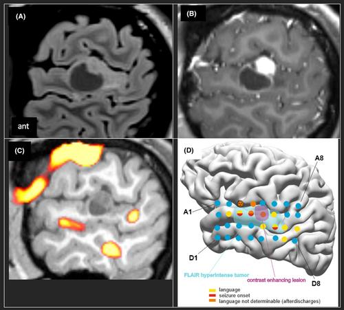 Electrical stimulation mapping guides individualized surgical approach in an epilepsy-associated tumor within language representing cortex