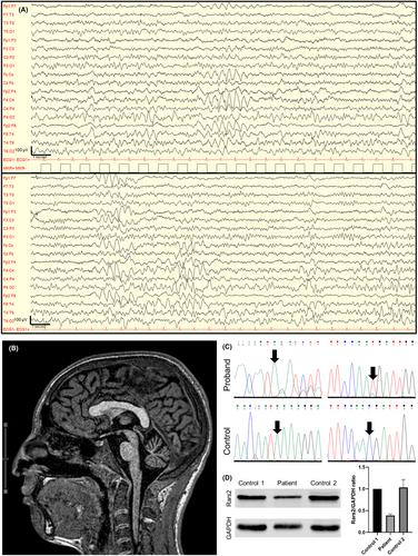 Soft cerebellar signs unveil RARS2-related epilepsy