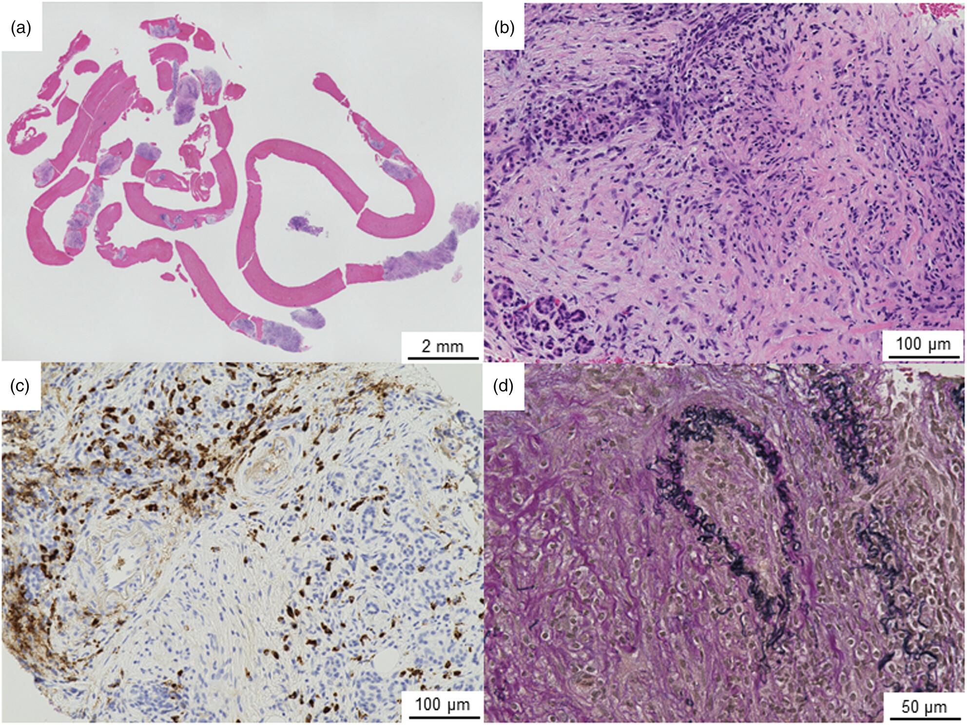 A prospective study on the histological evaluation of type 1 autoimmune pancreatitis using endoscopic ultrasound-guided fine needle biopsy with a 19-gauge Franseen needle