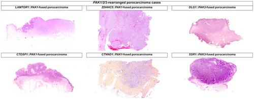 Porocarcinomas with PAK1/2/3 fusions: a series of 12 cases