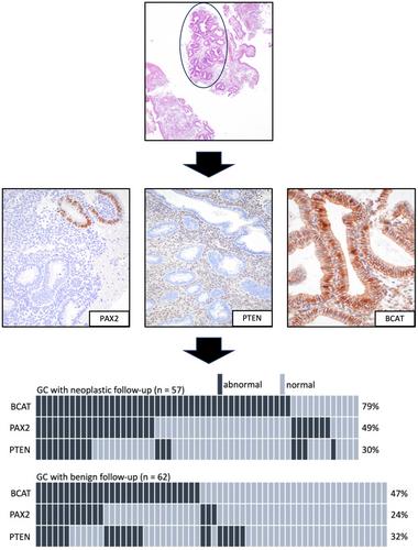 Lesions sub-diagnostic of endometrioid intra-epithelial neoplasia/atypical hyperplasia: value of morphology and immunohistochemistry in predicting neoplastic outcome