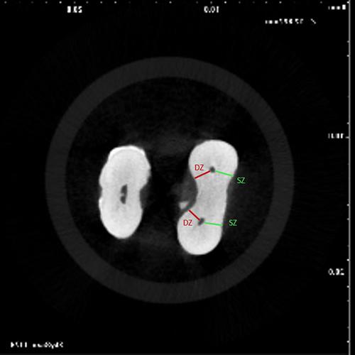 Shaping ability of three instrumentation system in moderately curved canals: A micro-CT study