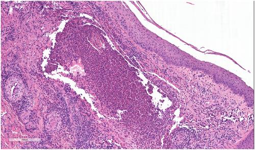 Immunotherapy associated Sweet syndrome in a patient with metastatic melanoma: A case report