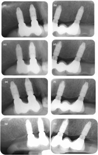 Marginal changes at bone-level implants supporting dental prostheses with or without intermediate standardised abutments after 36 months: Randomised controlled clinical trial