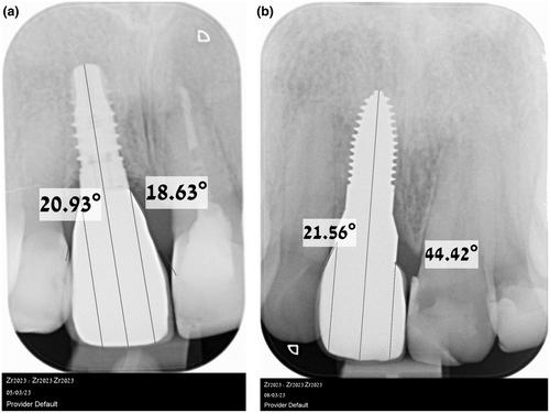 Discomfort/pain due to peri-implant probing at titanium and zirconium implants: A cross-sectional study