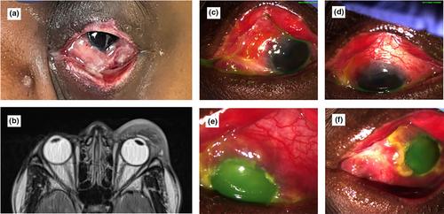 Severe ocular Mpox in person living with advanced HIV treated with extended course of tecovirimat