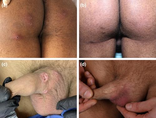 Scars are frequently found as late sequelae in individuals affected by the 2022 mpox outbreak