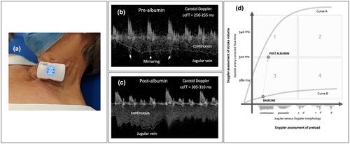 Optimising flow without congestion using the venous-arterial Doppler enhanced resuscitation framework