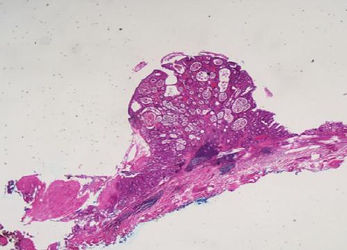 A tiny gastric adenocarcinoma of fundic gland type mimic polyp