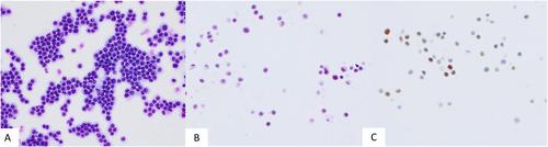 Utility and performance of cell blocks in cerebrospinal fluid cytology: Experience at two teaching hospitals